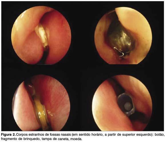 CORPO ESTRANHO NASAL Corpo estranho nasal