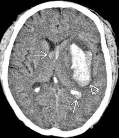 Figura 5 - Corte de TC mostrando lesão hiperdensa no hemisfério cerebral direito, com compressão