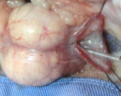 (H) Anastomose término-terminal (seta) entre a uretra peniana (*) e a uretra prostática.