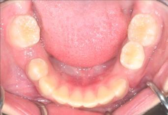 24 no primeiro período transitório da dentadura mista. Geralmente, este é causado pela discrepância entre ossos maxilares e os dentes, tendo como origem principal o fator genético (Fig. 1A).