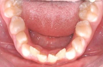 ambientais, onde a perda prematura de dentes decíduos é o principal fator contribuinte (Fig. 1B).
