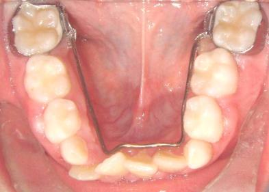 28 Arco Lingual O arco lingual serve para ancoragem e manutenção do comprimento do arco, atua impedindo a migração mesial dos primeiros molares permanentes inferiores (Fig.