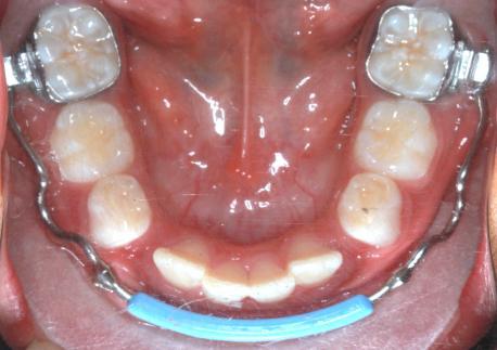 29 expansão dentária transversal, sendo indicada para o tratamento do apinhamento dentário inferior e como mantenedor de espaço em casos de perdas precoces de dentes decíduos pósteroinferiores,