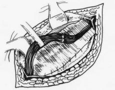Reparo Falci-Lichtenstein (FL) Uma tela de Polipropileno (Márlex), previamente preparada, foi modelada de acordo com a região inguinal a ser operada.