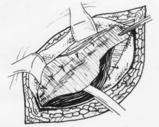 A seguir a tela é suturada inferiormente ao ligamento inguinal com sutura contínua de Prolene 2-0 até o anel inguinal profundo; medialmente à bainha do músculo reto do abdome; superiormente na