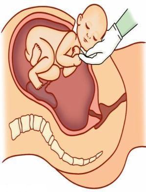 CAUSAS DA SURDEZ: PERINATAL momento do nascimento ou nas primeiras horas após Prematuridade Pós maturidade Anóxia