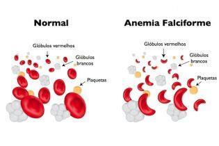 2.2 FALCIFORME Anemia falciforme é uma doença genética do tipo variante de hemoglobina, uma alteração na estrutura da hemoglobina.