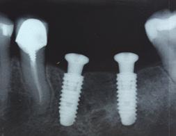 3 implantes apresentaram uma perda óssea superior ou igual a 2 mm (Fig. 23).