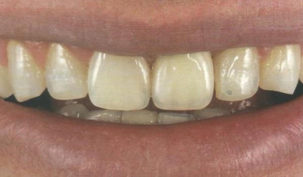 respeito à inclinação dos dentes no sentido mesial em uma
