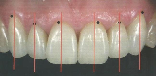 Seguindo corretamente a posição do zênite nas restaurações diretas, nos preparos para as restaurações indiretas e no posicionamento correto de implantes, obtém-se harmonia de contorno e de posição