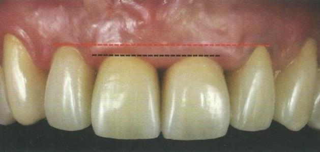 ) 5.1.1.5 Contatos proximais Eles surgem quando pequenas áreas (2 X 2mm) entre dentes adjacentes entram em contato.