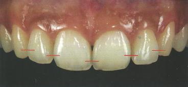 21 Figura 10 - Localização correta dos pontos de contato 5.1.1.6 Áreas de conexão São áreas interproximais que parecem estar em contato quando se observa a dentição anterior em vista frontal.