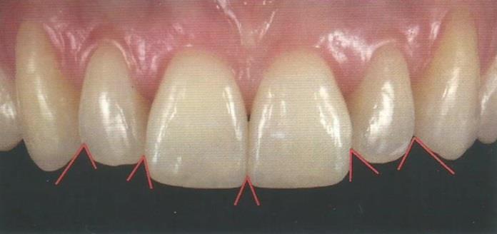22 Figura 13 - Posicionamento das ameias incisais, baseado na localização das áreas de conexão 5.1.1.7 Ameias incisais Ameias incisais bem definidas são uma característica de dentes jovens, sem qualquer padrão de desgaste incisal.