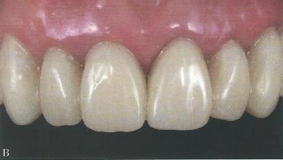 1.9 Curvatura incisal superior O contorno formado pelas bordas incisais é fundamental na harmonização de um sorriso.