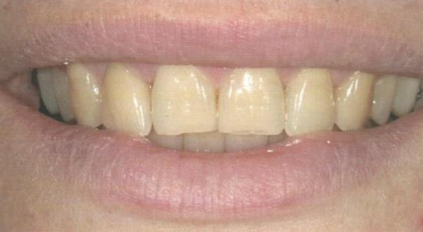 1.10 Corredor bucal O corredor bucal é definido pelo espaço entre as faces vestibulares dos dentes posteriores e o ângulo formado pelas comissuras