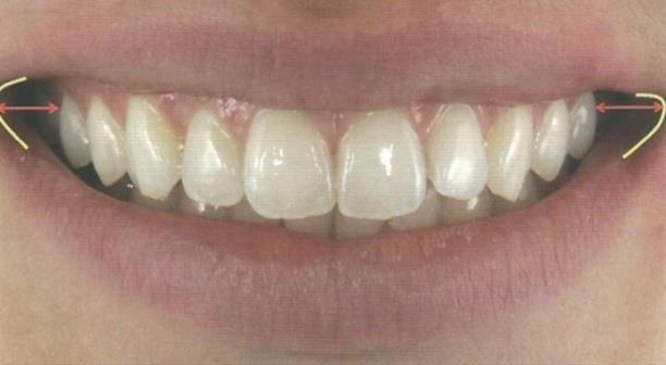 Nessa situação, percebe-se que há uma progressão estética na dentição de anterior para posterior, tanto na perda de luminosidade, quanto na percepção