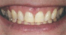 25 Figura 22 - Corredor bucal amplo Figura 23 - Corredor bucal nulo 5.1.1.11 Forma dental e proporcionalidade O formato dos dentes naturais anteriores é particular para cada pessoa.