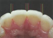 incisal, conferindo a