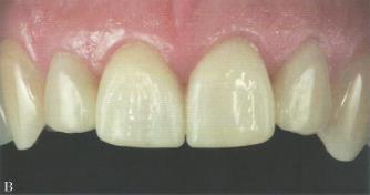 reflexão de luz do dente 11 está mais apical em relação ao dente