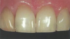 30 5.1.1.12 Textura dental Assim como a morfologia, a textura de superfície é diversificada na dentição natural.