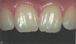 Com o passar dos anos a textura, assim como outras características de forma, vão-se perdendo. Os dentes tornam-se menos brilhantes logo, mais escuros (Figura 35).