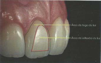 Das três dimensões da cor (matiz, croma e valor) o valor é, sem dúvida, o mais importante, pois é o responsável por agregar luminosidade, o brilho, ao dente.