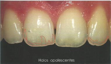 32 Figura 39 - Terços incisais evidenciando o grau de translucidez e o padrão de opalescência Figura 40 - Fenômeno ótico de opalescência evidenciado na pedra opala.