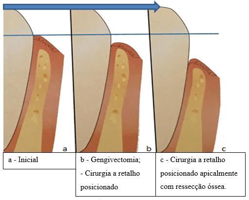 37 condições de manutenção das restaurações; melhoria cosmética; capacitar a realização de procedimentos restauradores sem violar a distância biológica e; facilitar a melhora da higiene bucal.