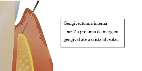 39 Figura 50 - Incisão em bisel interno Fonte: Sato (2002). 5.6.