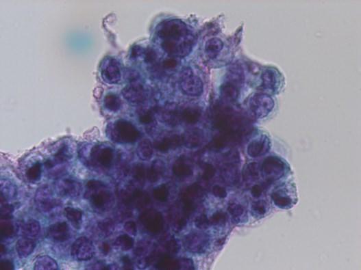 Stella, alterações celulares provocadas pela radioterapia e por colheitas vigorosas e ainda amostras contendo células do segmento uterino inferior 1.