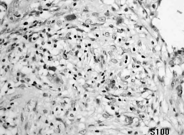 biopsia é dispensável LBA / Biopsia