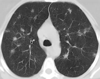 Chest 1999 Tratamento Opção inicial Corticosteróide Doença progressiva, apesar de corticosteróide Cladribina,