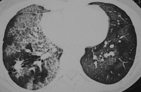 Material lipoproteináceo (surfactante) em alvéolos Origem alteração em macrófagos e neutrófilos