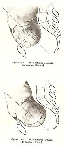 ASSINCLITISMO devido ao volume grande da cabeça fetal e à dificuldade da passagem, ela se movimenta, oferecendo uma das metades de cada vez sinclitismo: a sutura sagital