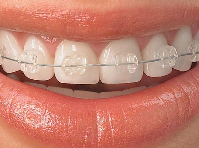 No tratamento, é aplicada uma suave pressão nos fios que passam pelos braquetes, de modo que os dentes se movam para o alinhamento correto gradualmente.