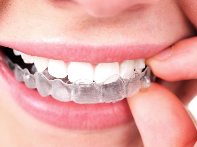 Tipos de Aparelhos Ortodônticos Alinhadores Invisalign Os alinhadores são o que há de mais atual e tecnológico na ortodontia. Sem qualquer tipo de metais e fios.