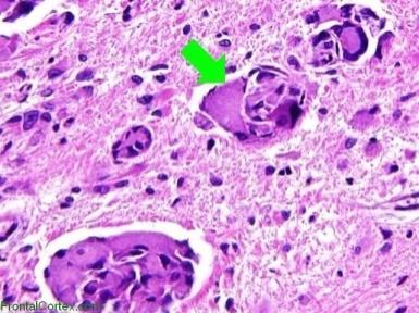 DIAGNÓSTICO Galactocerebrosidase leucócitos: 0,23 nmol/h/mg proteína (v.r. 0,71-3,59) Mutação do gene GALC localizado no cromossomo 14q31 confirmação molecular.