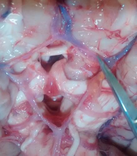 22 Artéria cerebral anterior Artéria comunicante anterior Segmento carotídeo Artéria comunicante posterior Artéria cerebral posterior Figura 1.