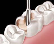 B. Uma banda matriz fina e macia deve ser aplicada ao redor do dente preparado e brunida de modo a permitir a