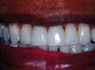 FACETAS DENTES SEM MANCHAMENTO: TÉCNICA DE 2 CAMADAS Para as dentições sem manchamento, que não requerem a aplicação de uma camada de mascaramento ou de opacificação, prepare o