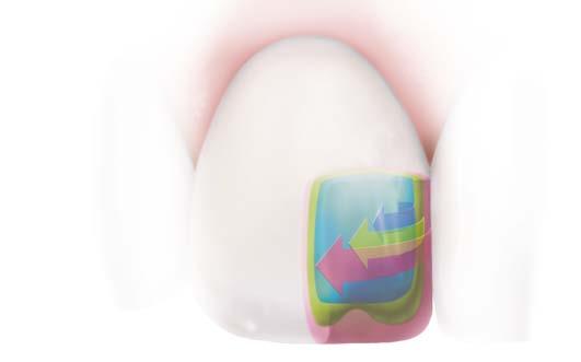 CORES DE ESTHET-X HD Esthet-X HD tem 3 diferentes séries de opacidade, que vão pemitir replicar a estrutura natural do dente.