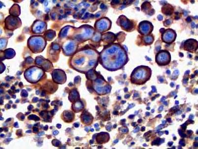 linfonodo. DAB e contracoloração com Hematoxilina de Harris. Obj. 40x. Figura 7: Fotomicrografia de neoplasia mamária canina.