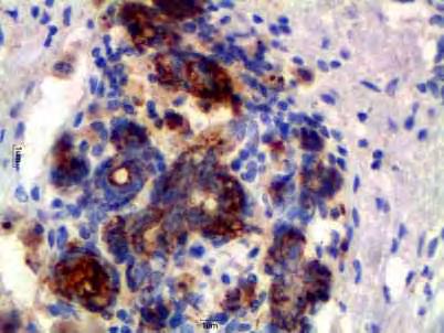 23 Figura 12: Fotomicrografia de neoplasia mamária canina. Notar marcação imuno-histoquímica nuclear para Oct-4.