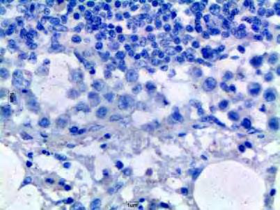 Obj. 40x Figura 13: Fotomicrografia de neoplasia mamária maligna com metástase em linfonodo.