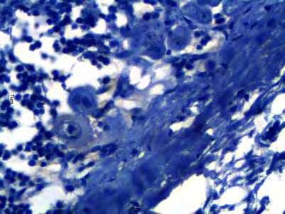 26 Figura 18: Fotomicrografia de neoplasia mamária maligna canina metastática em linfonodo. Notar ausência de marcação em células epiteliais indiferenciadas na reação imuno-histoquímica para ALDH-1.