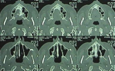 PROPOSIÇÃO Avaliar clinicamente os enxertos ósseos retirados da crista do osso ilíaco, para reconstrução total de maxilas atróficas e posterior instalação de implantes ósseointegráveis.