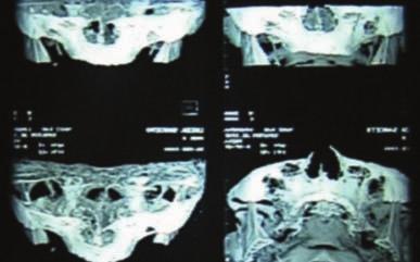 insuficiência óssea total do rebordo alveolar, para posterior reabilitação com implantes ósseointegrados. A idade dos pacientes variou de 38 a 61 anos, com média de 49,5 anos.