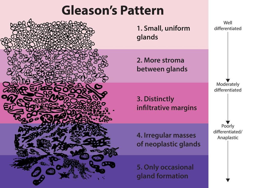 14 Gleason 6; grau 2 - escore Gleason 3+4=7; grau 3 - escore Gleason 4+3=7; grau 4 - escore Gleason 4+4=8; grau 5 - escore Gleason 9 ou 10 (EPSTEIN, 2015).