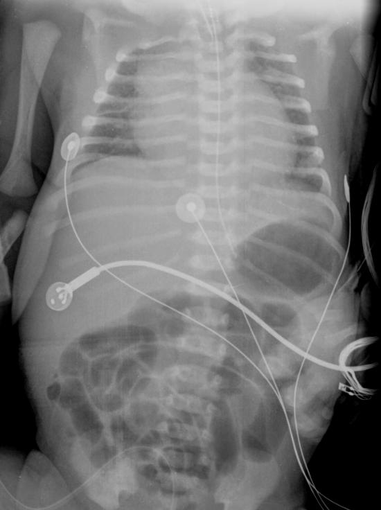 tóraco-abdominal índice cardiotorácico UCIN HSJ