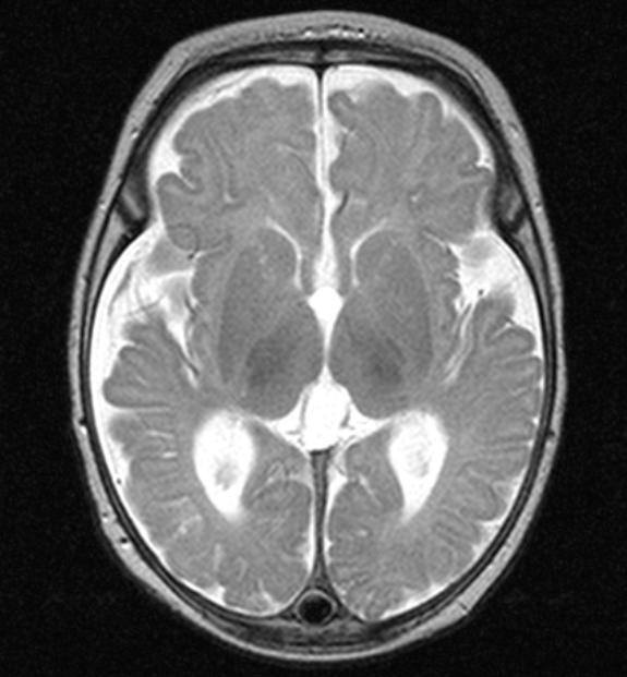 RM cerebral(d78): atrofia supratentorial mto significativa.